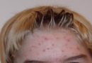 Acne: saiba como tratar acne e espinhas