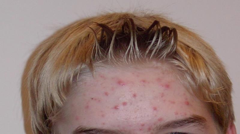 Acne: saiba como tratar acne e espinhas